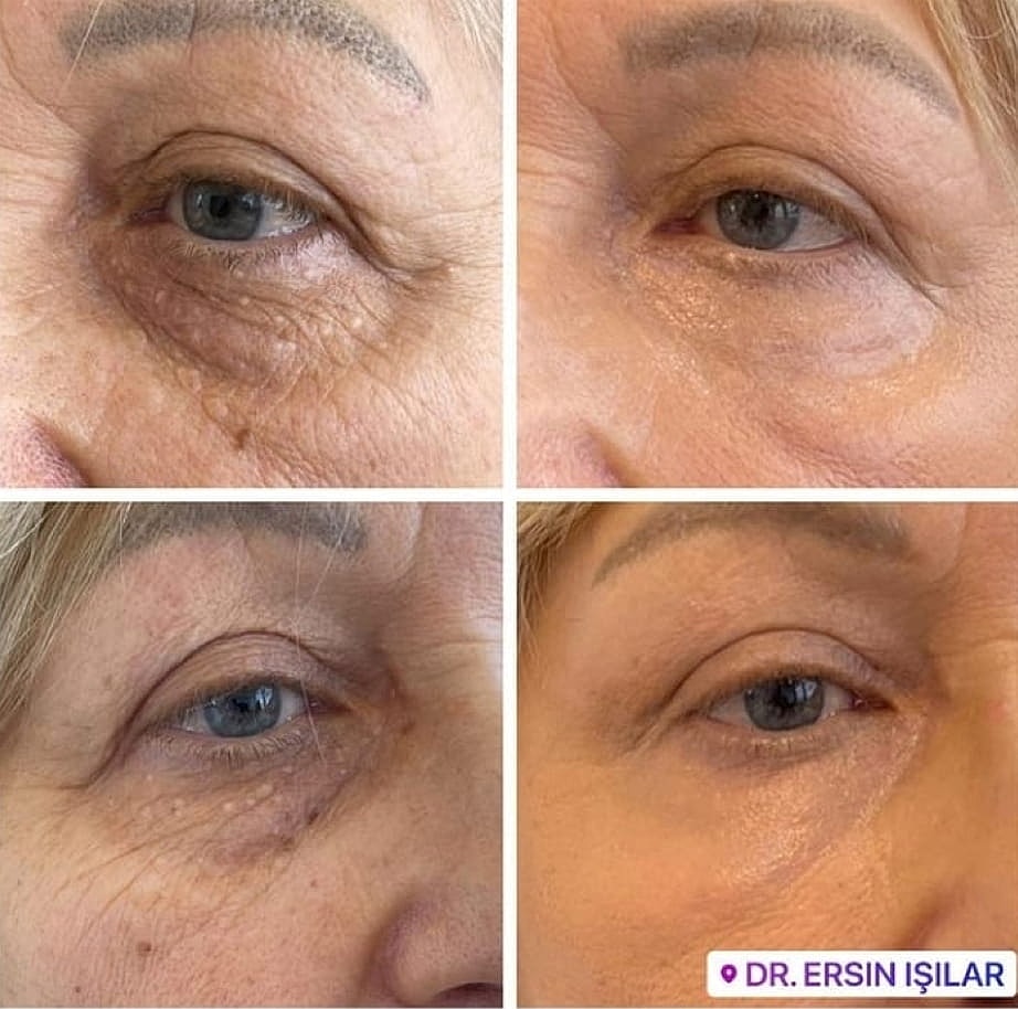 Plexr Before & After