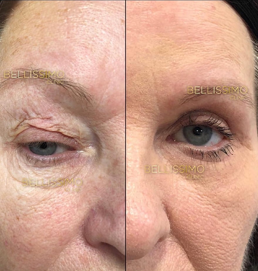 Plexr Before & After