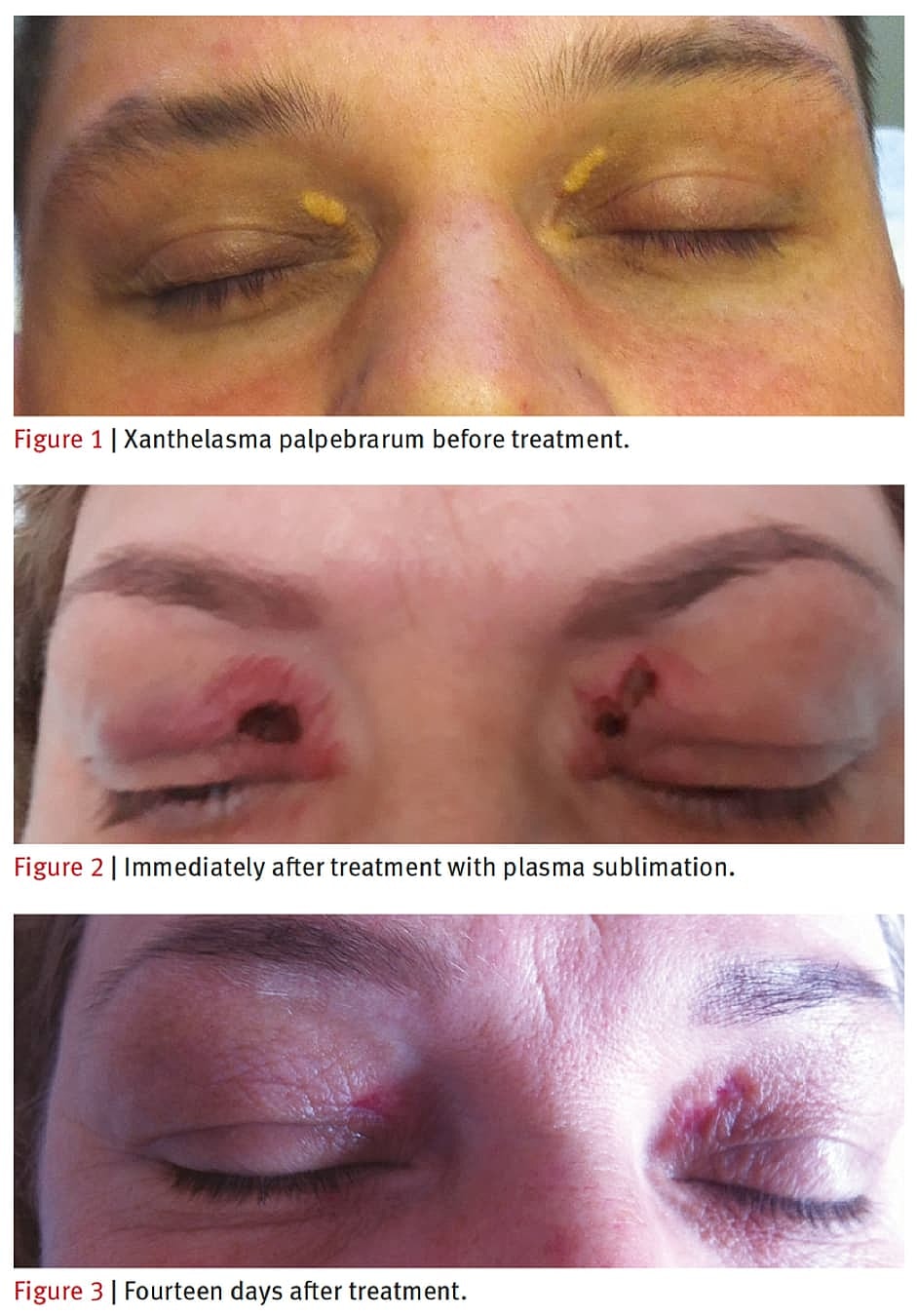 Plexr Before & After
