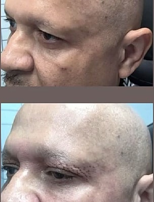 Plexr Before & After