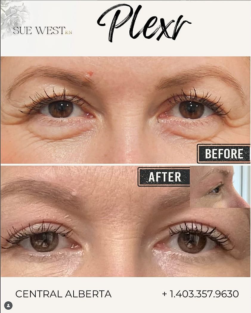 Plexr Before & After