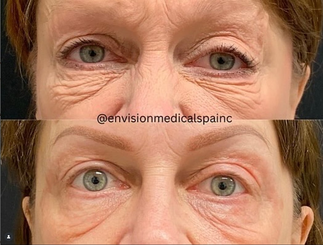 Plexr Before & After