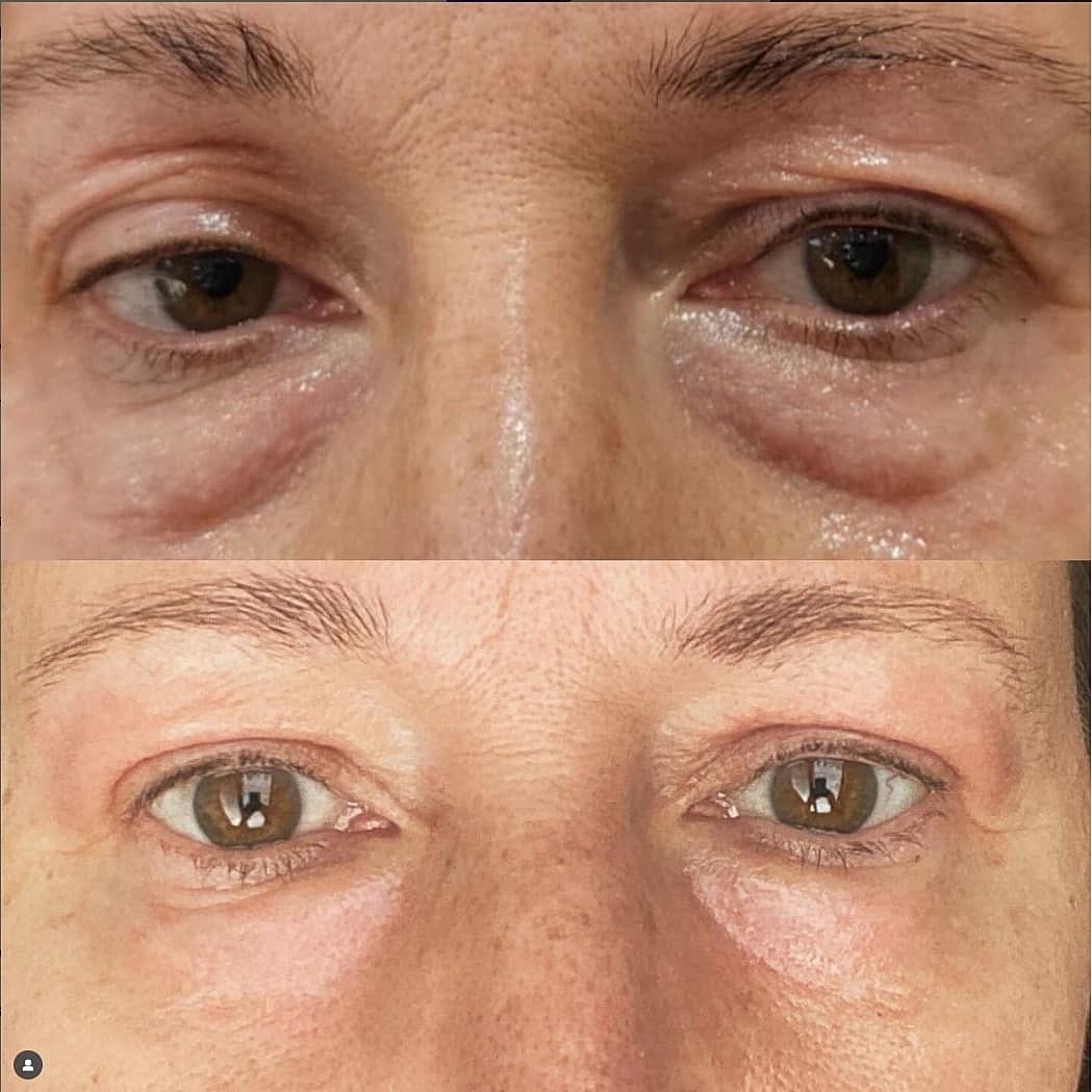 Plexr Before & After