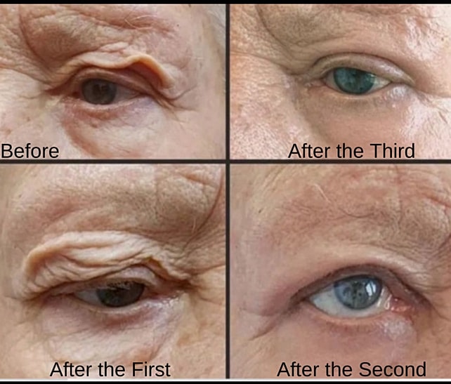 Plexr Before & After