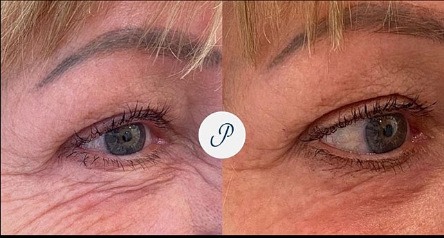 Plexr Before & After