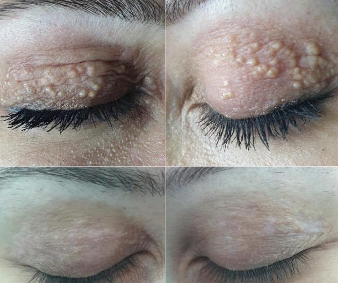 Plexr Before & After