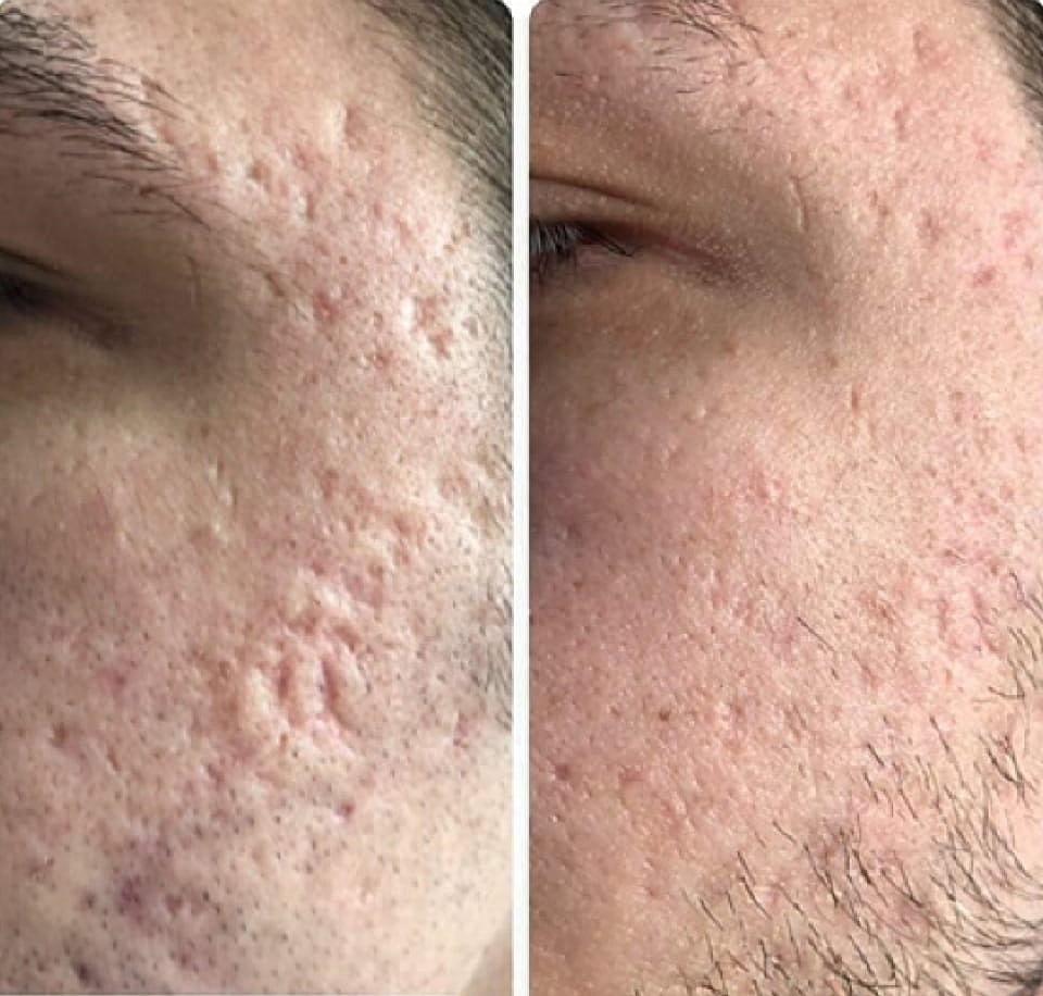 Plexr Before & After