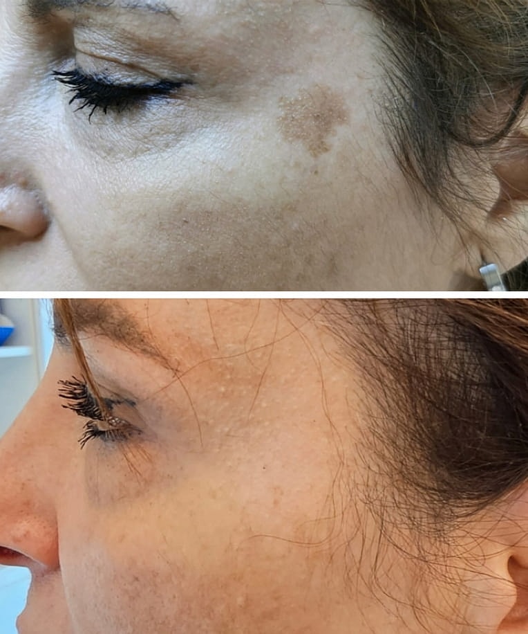 Plexr Before & After