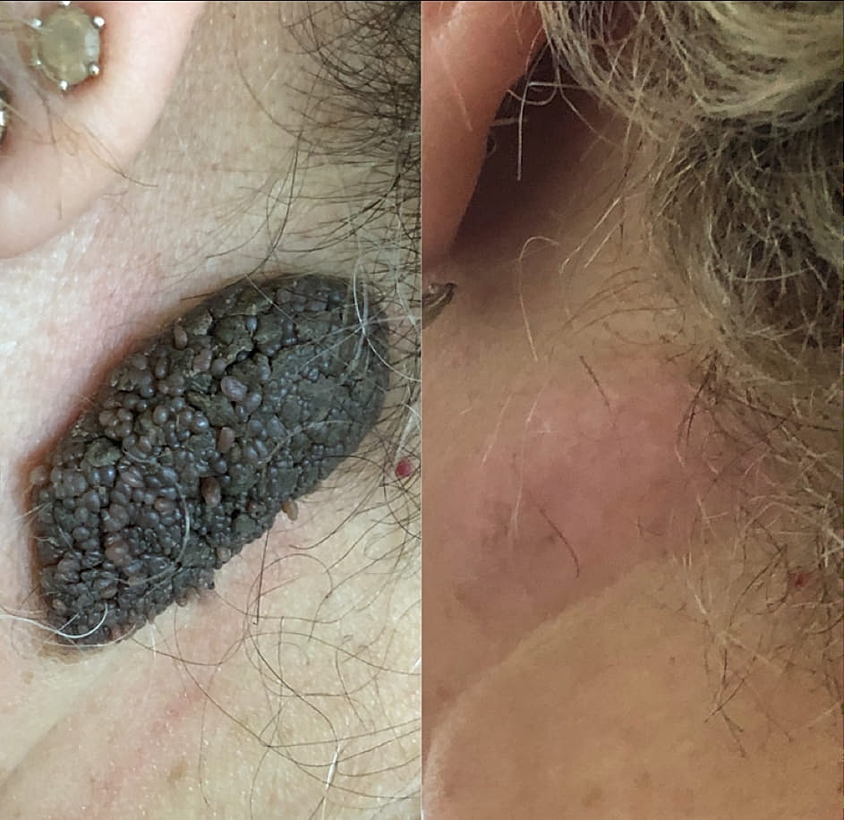 Plexr Before & After