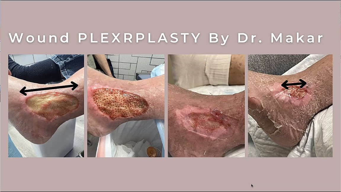 Plexr Before & After