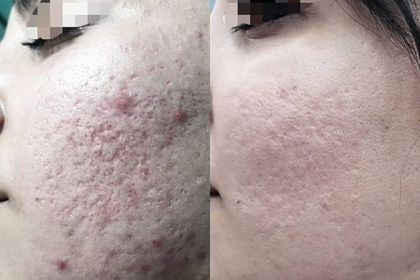 Plexr Before & After