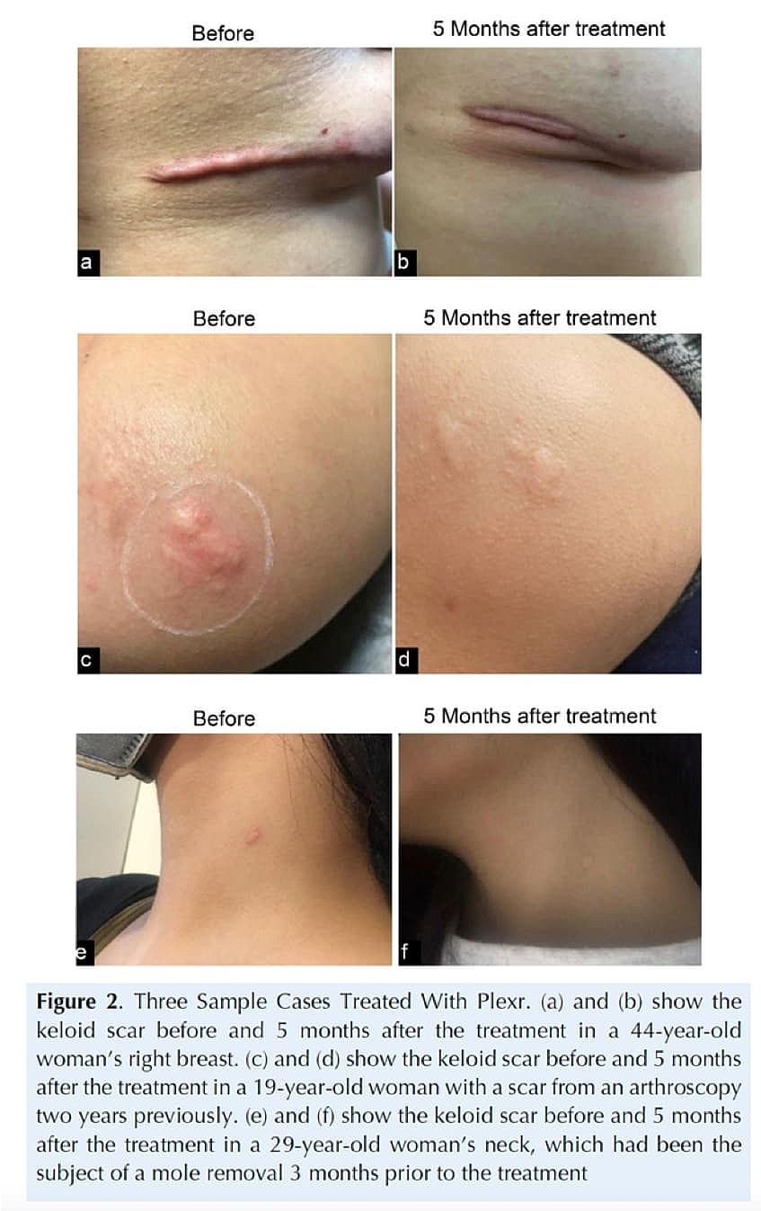 Plexr Before & After