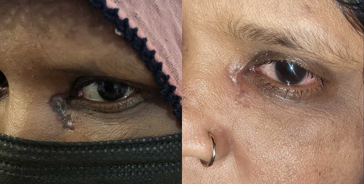 Plexr Before & After