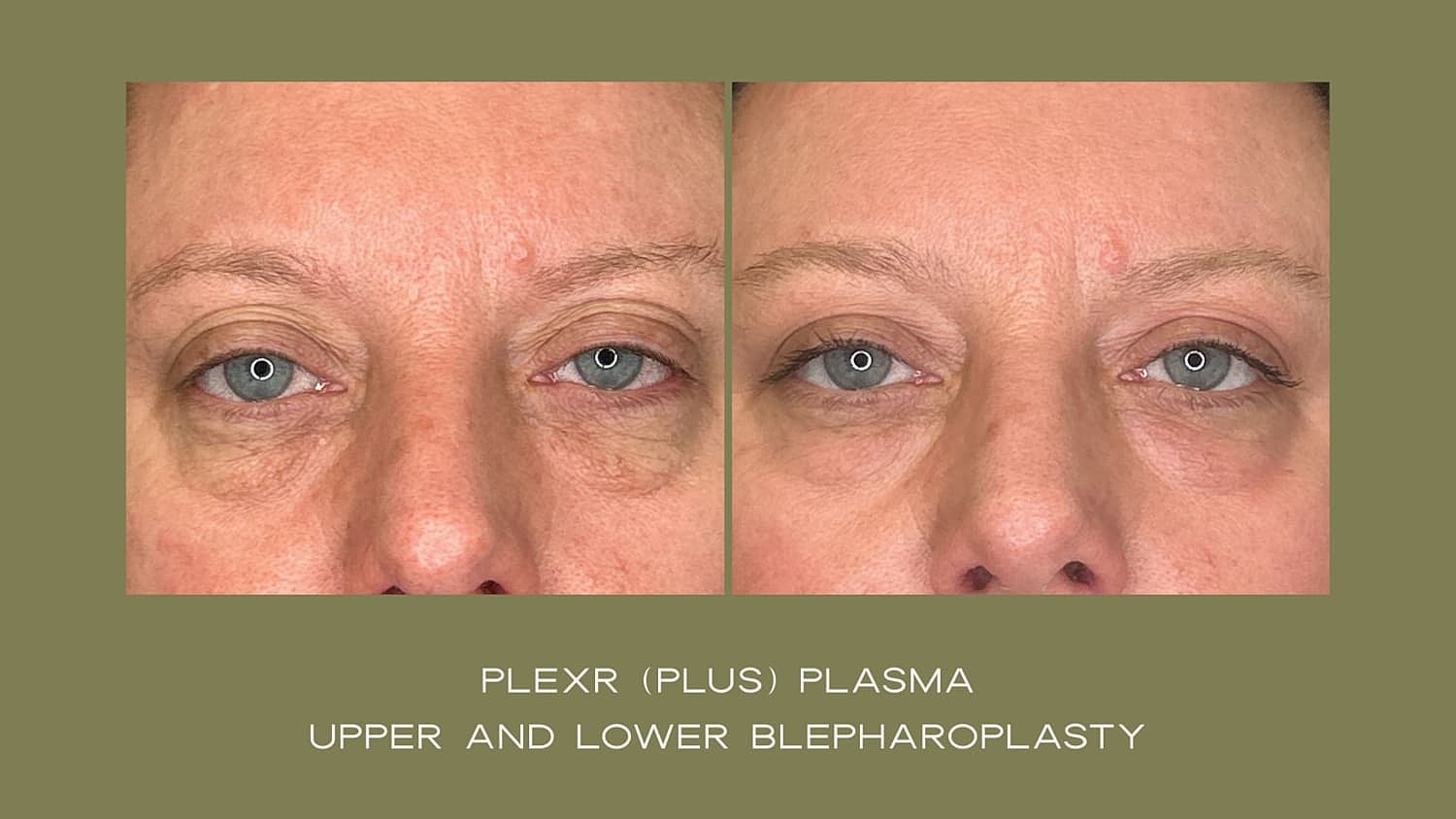 Plexr Before & After